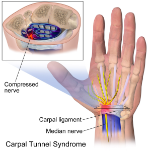 carpal_tunnel_syndrome
